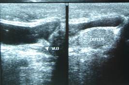 ureteric-re-implantation-3