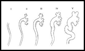 vesicoureteric-reflux-1
