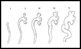 vesicoureteric-reflux-1