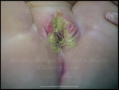 Anorectal Malformations