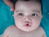 Cleft Lip and Palate