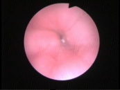 Endoscopy (Gastroscopy, Bronchoscopy, Cystoscopy)