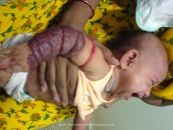 Haemangiomas