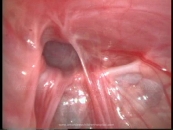 Laparoscopy in Inguinal Hernia 