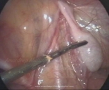 Laparoscopy in Undescended Testis