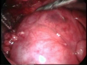 Laparoscopy, Thoracoscopy