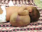 Lymphangiomas