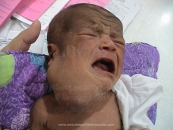 Neck Cysts and Sinus