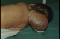 Occipital Encephalocele
