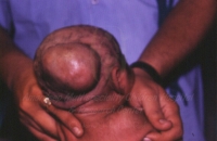 Occipital encephalocele