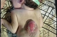 Lumbar Open neural tube defect with paraplegia