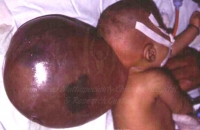Large Occipital encephalocele
