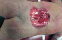 Open neural tube defect