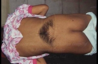 Tuft of hair over back (Occult spina bifid a)