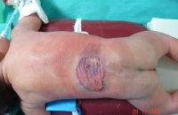 Lumbar Meningomyelocele