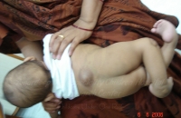 Lumbosacral meningomyelocele with defective legs