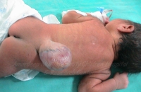 Sacral Meningomyelocele