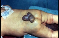 Lumbosacral Meningomyelocele