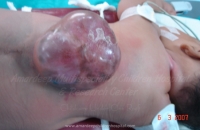 Lumbar Meningomyelocele