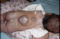 Double Meningomyeloceles