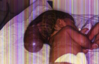 Occipital Encephalocele