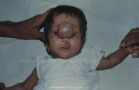 Frontal Encephalocele