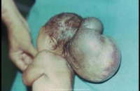 Large Occipital encephalocele