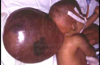 Large Occipital encephalocele