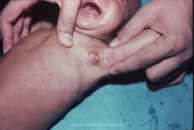 Tumors and Masses